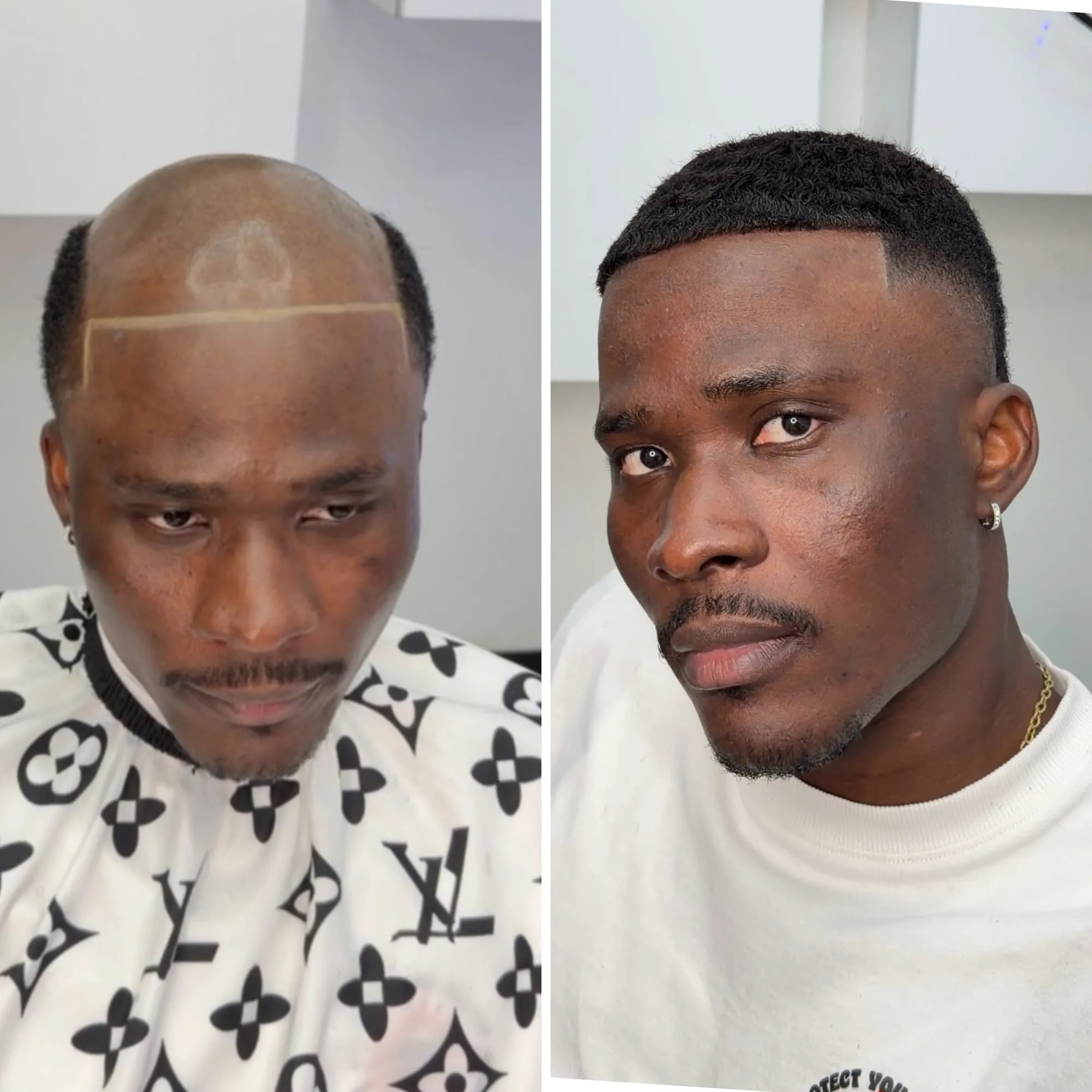 Before and after: a client with his hairline mapped for a new system, then with a clean, natural front hairline and short cut after the install.