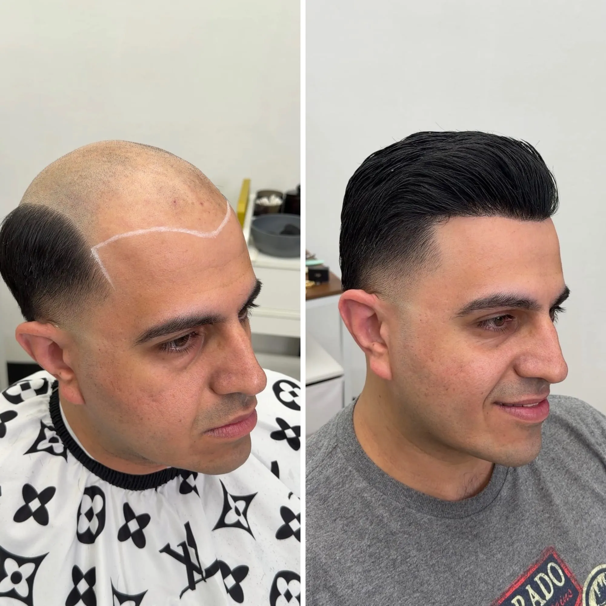 Before and after: a client with a mapped hairline before his install, then with a styled dark quiff and skin fade after his hair unit was fitted.
