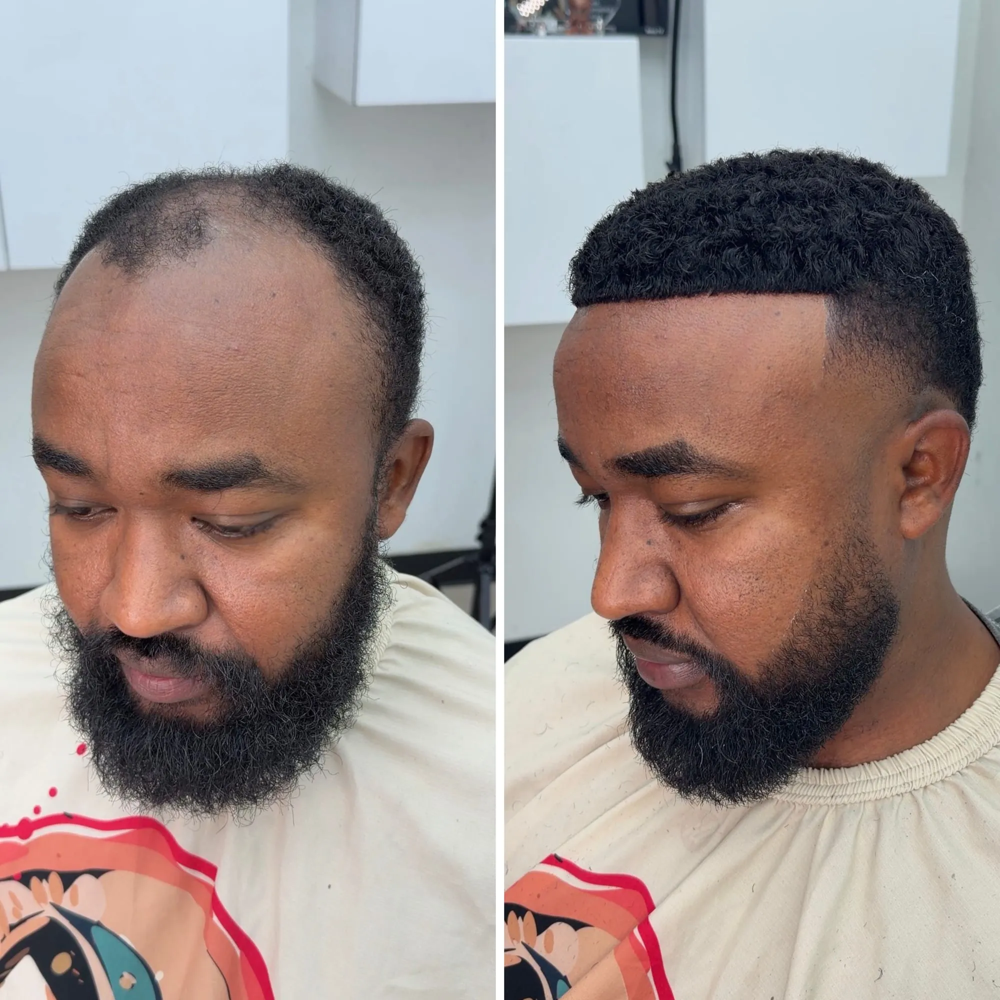 Before and after: a bearded client with a bald crown, then with short black textured hair and a clean fade after his hair system install.