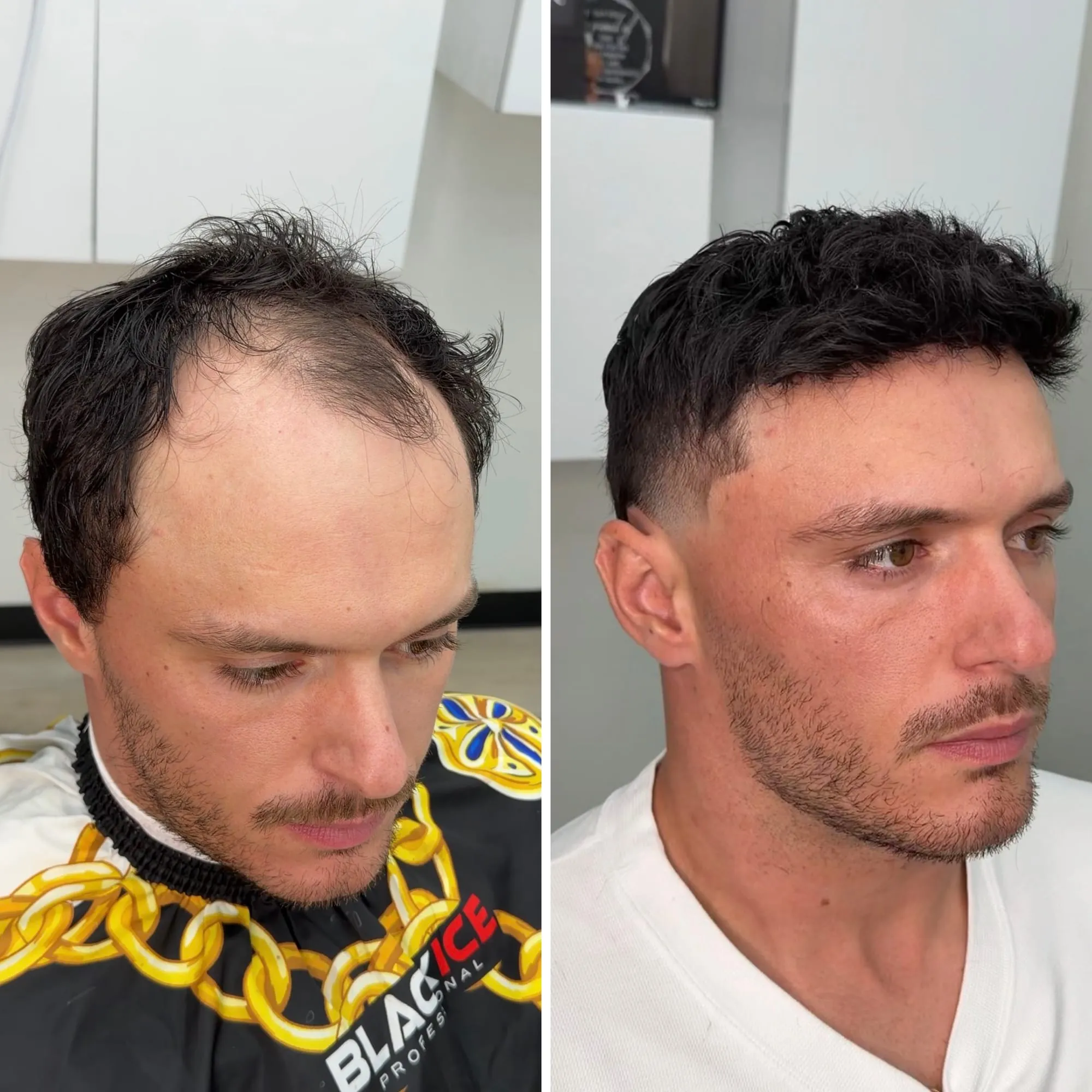 Before and after: a client with thinning hair on top, then with a full dark textured style and fade following his hair replacement.
